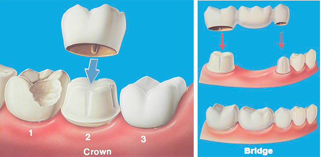 Great Junction Dental Crown and Bridge