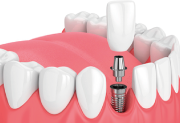 great-junction--dental-dental-implants