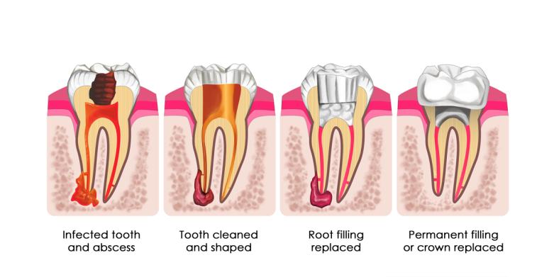 Great Junction Dental Root Canal