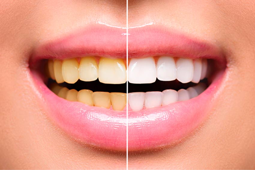 Great Junction Dental Teeth Whitening